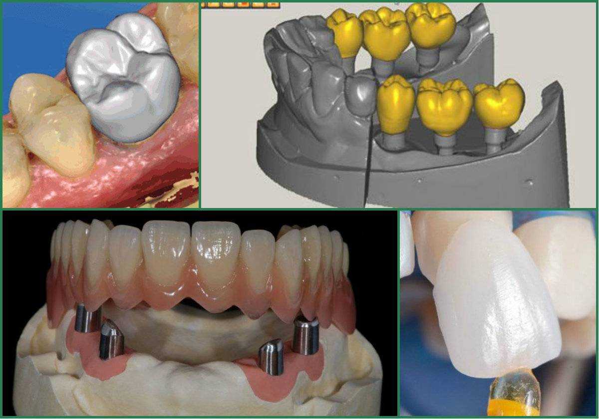 9 современных методов протезирования зубов по мнению врачей