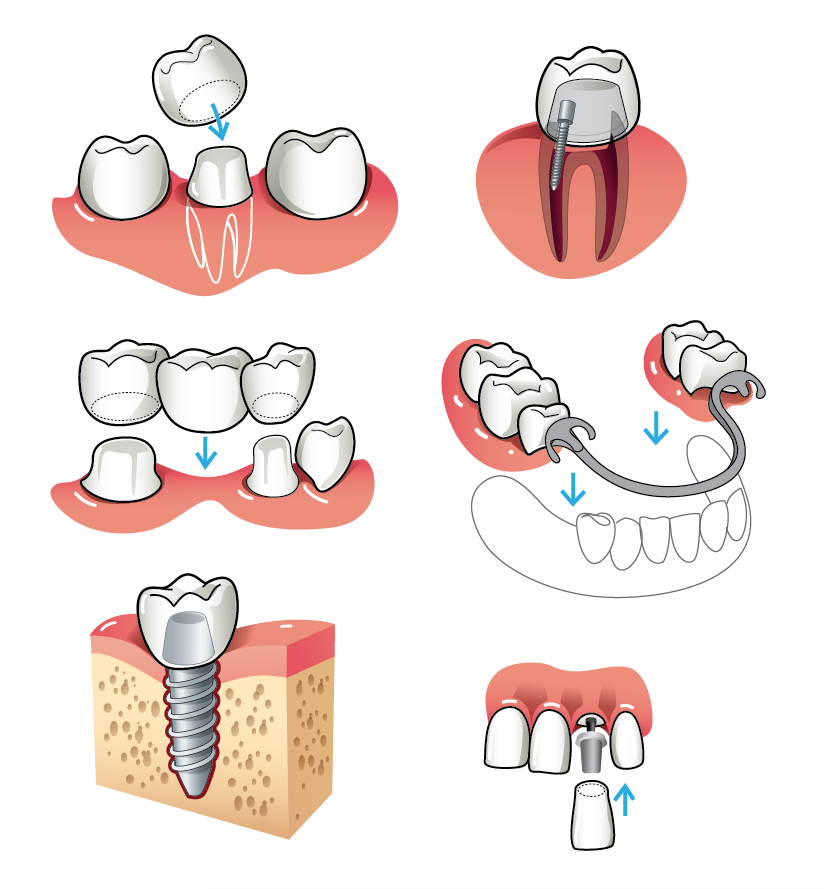 Лучшие съемные зубные протезы – статьи стоматологической клиники «доктор мартин»